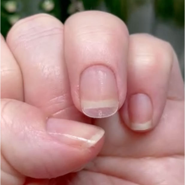 Terry's Nails: Symptoms, Causes & Treatment